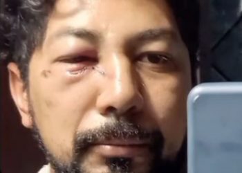 Veterinário roraimense sofre grave acidente com cavalo e faz campanha virtual para pagar cirurgia urgente de reconstrução no rosto