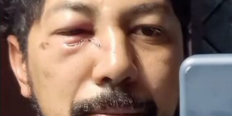 Veterinário roraimense sofre grave acidente com cavalo e faz campanha virtual para pagar cirurgia urgente de reconstrução no rosto